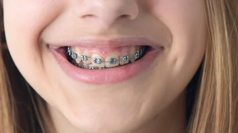 Braces for Children