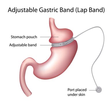 diagram of adjustable gastric band