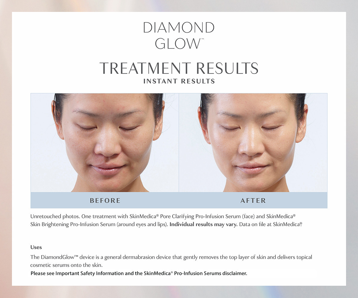 six week results from diamond glow treatment before and after