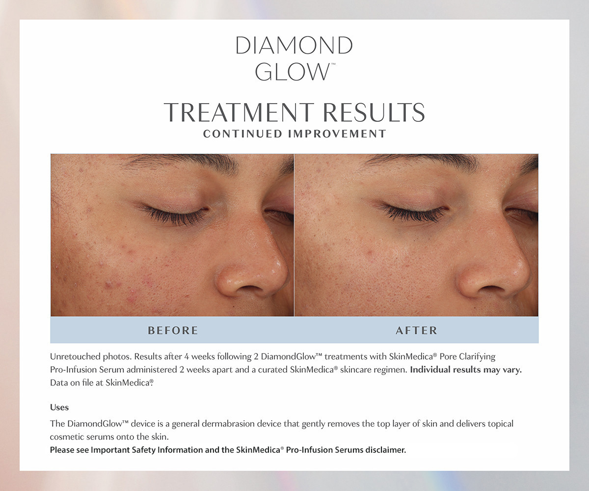 four week results from diamond glow treatment before and after