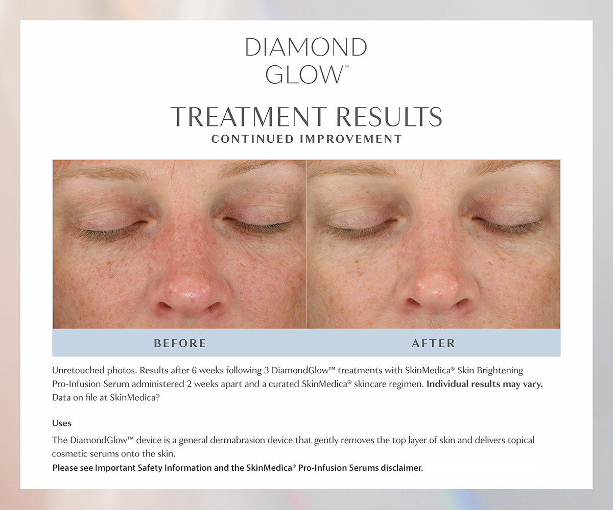 instant results from diamond glow treatment before and after