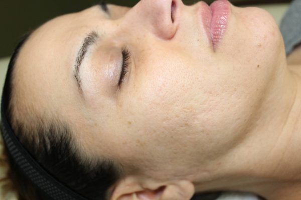 cheek of woman after picoway treatment