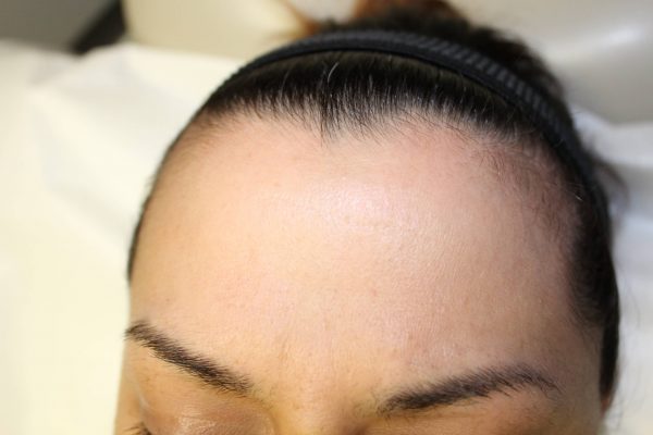 forehead of woman after picoway treatment