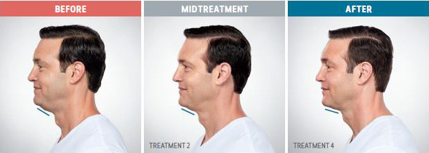 Side profile of a man showing chin changes labeled Before, Midtreatment, and After.