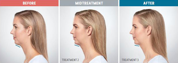 Side view of woman before, during, and after chin treatment, showing reduced double chin.