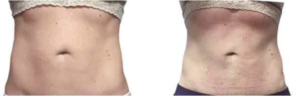 Coolsculpting before and after photo of woman's abdomen.