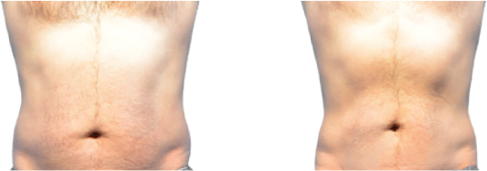 Abdomen of man before and after Cooltone treatment.