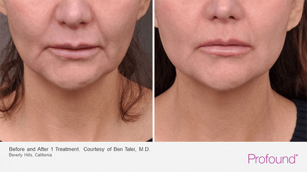 Juvederm before & after treatment photo