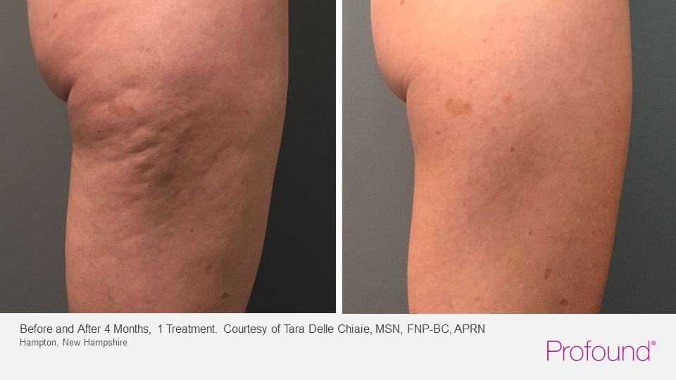 before and after of profound system cellulite removal on woman's thighs