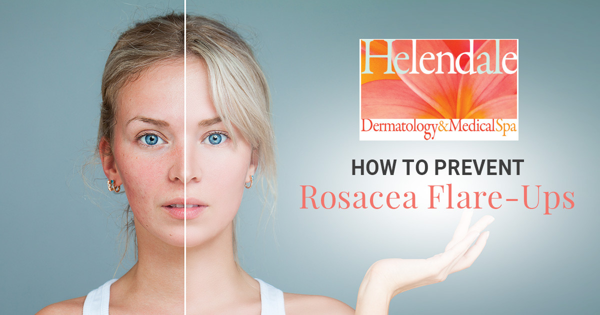 how to prevent rosacea flare-ups