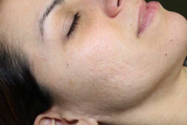 cheek of woman before picoway treatment