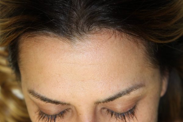 forehead of woman before picoway treatment