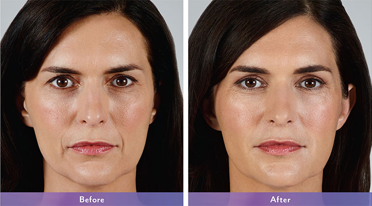Side-by-side photos of a womans face before and after a cosmetic treatment.