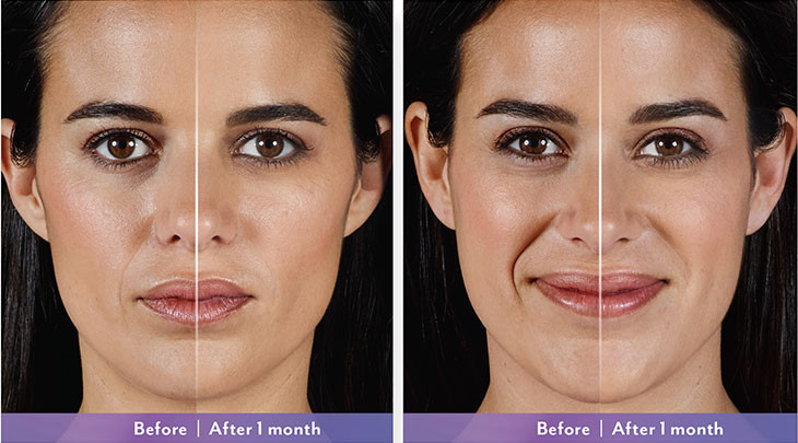 Side-by-side of a womans face before and after 1 month, showing smoother, fuller skin.