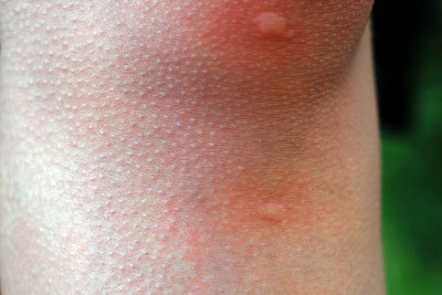 Mosquito bite on skin dermatology condition