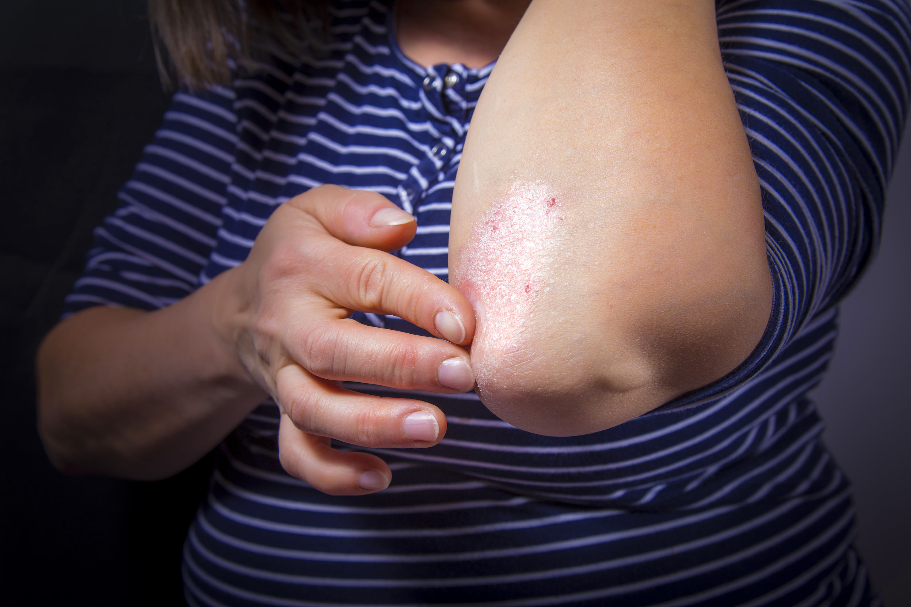woman pointing out psoriasis on her elbow