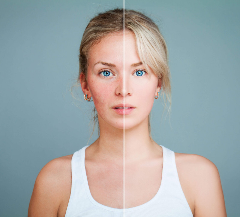 split screen before and after of woman with rosacea treatment on her cheeks