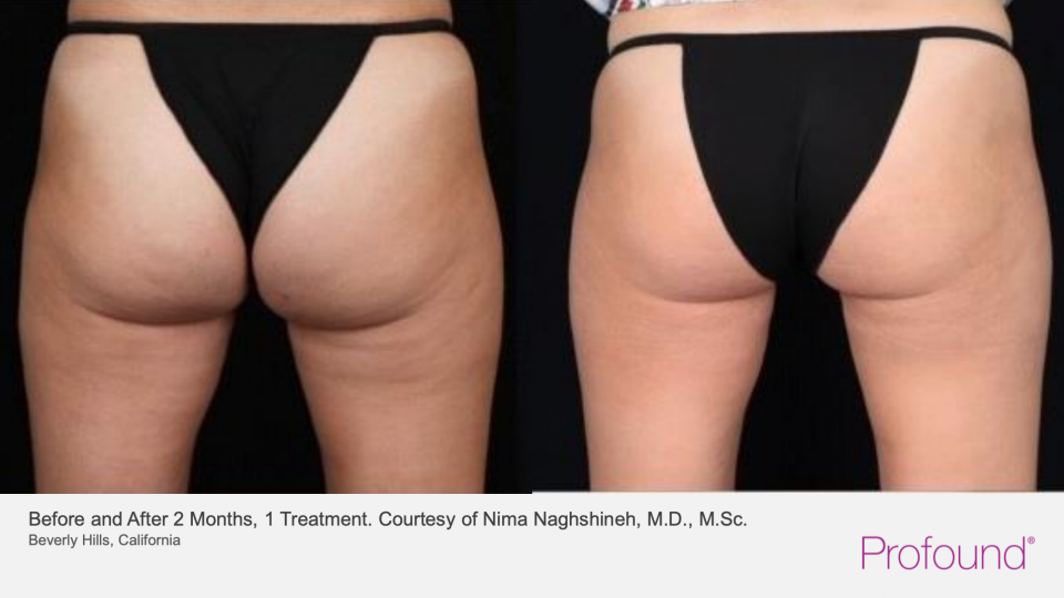 before and after of profound system cellulite removal on women's buttocks
