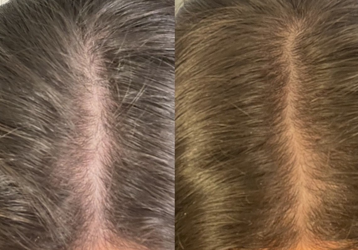 Nutrafol results - Before and after month 3