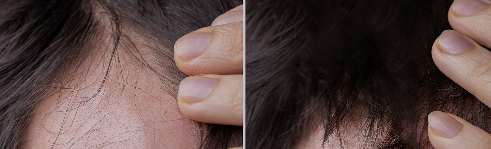 before-after-hair-restoration