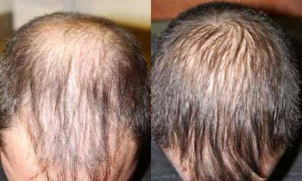 Frank - Before and after NeoGraft procedure