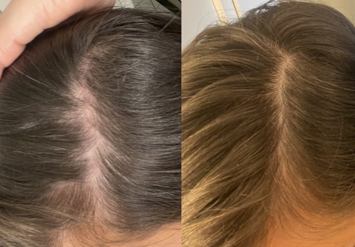 Nutrafol results - Before and after month 1