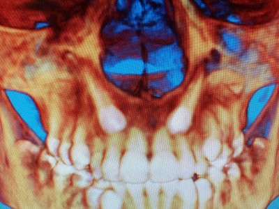 iCAT 3D scan of mouth