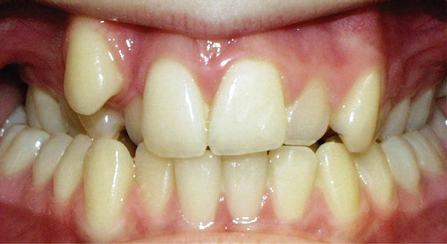 smile before damon brace system