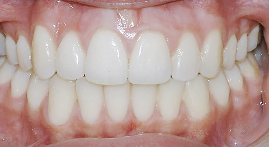 smile after damon braces system
