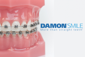damon braces system