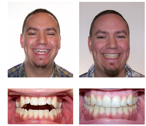 man with temporary anchorage device for teeth straightening before and after