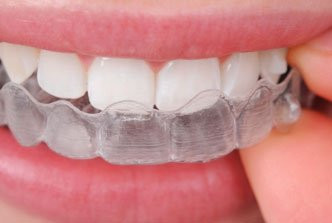 A close-up of someone placing a clear aligner tray over their teeth with their fingers.