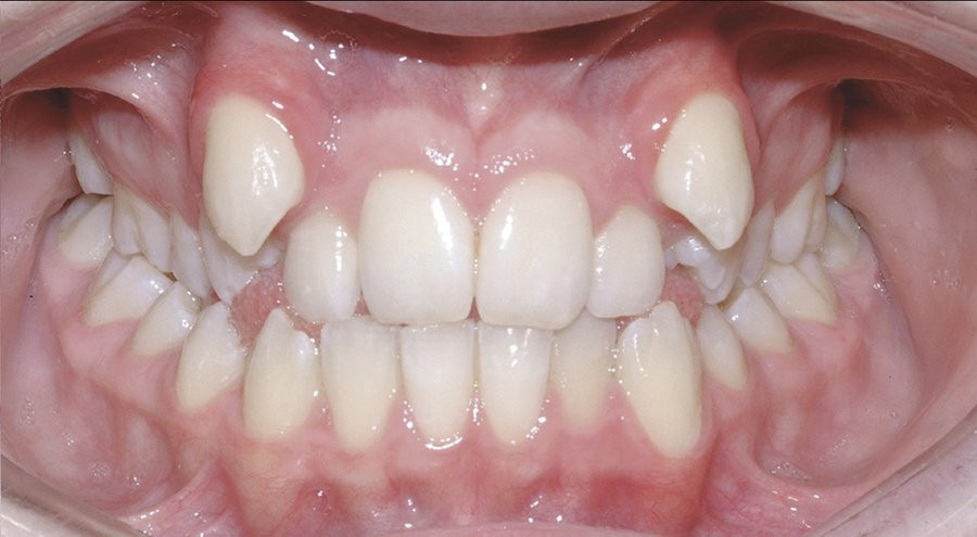 teeth before damon brace system