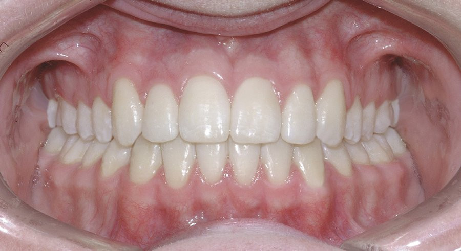 teeth after damon brace system