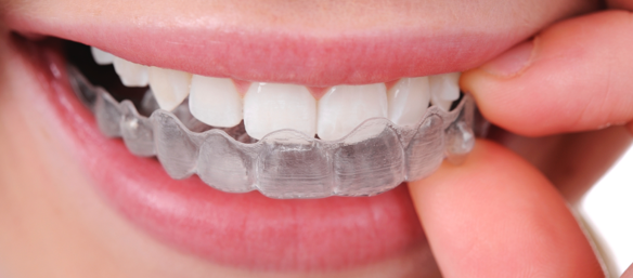 teen inserting invisalign teeth aligners in their mouth