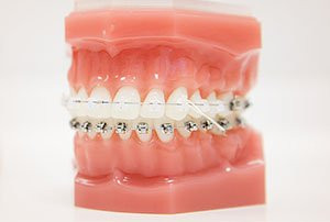 Dental model showing teeth with metal braces and rubber bands on both the upper and lower jaws.
