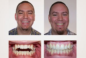 Man smiling in before-and-after photos, showing dental improvement with straighter, whiter teeth.